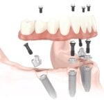 Fogbeültetés és all on 4 fogpótlás